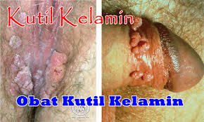 Illustration for article titled Obat Kutil Kelamin Vagina Di Apotik